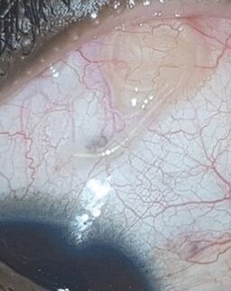 NEOflorax helped to get rid of a worm in the eye