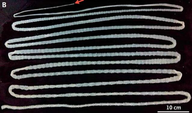 tape from the human body